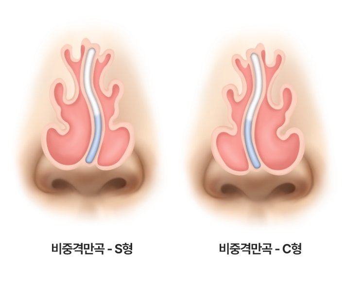비중격만곡증 인트로 이미지